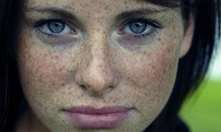 Гиперпигментация: причины и основные методы лечения
